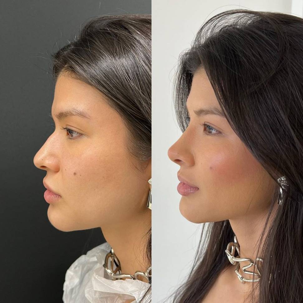 Antes e Depois Toxina Botulínica