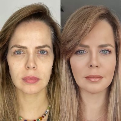 Antes e Depois Fios de PDO